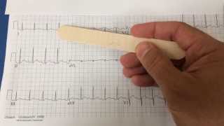 pericarditis on EKG [upl. by Roi]