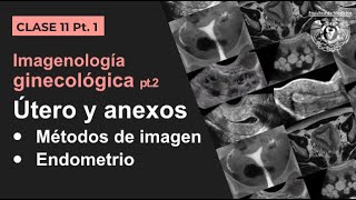 111  Imagen Ginecológica Métodos de estudio y patología endometrial [upl. by Sairahcaz]