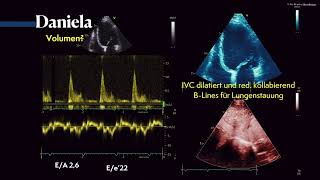 Diastolische Dysfunktion PWDoppler amp Volumenstatus im Ultraschall 〖Ultraschall〗 💘💫 [upl. by Asereht]