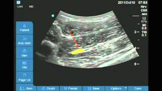 Ultrasound guided anterior sciatic nerve block [upl. by Ivel]