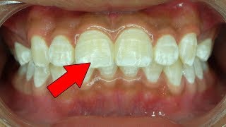 7 Ways to Get Rid Of White Spots on Teeth [upl. by Friedman173]