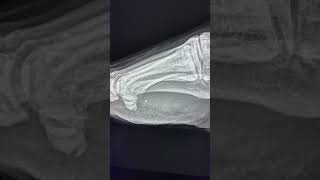 Medial hallux sesamoid fracture  Not to miss on foot Radiograph [upl. by Meit]