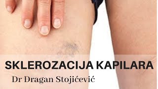 Uklanjanje proširenih kapilara skleroterapija sklerozacija vena cene cena cenovnik [upl. by Aicilyt]