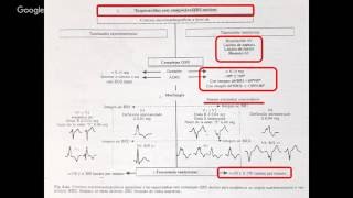 TAQUICARDIA VENTRICULAR [upl. by Marsland]