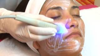 Radiofrecuencia Facial o Lifting sin cirugía [upl. by Rutledge]