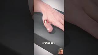 How toe to thumb surgery work body doctor subscribe viral subscribe [upl. by Leinadnhoj]