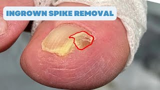 Ingrown SPIKE Removal FAILED SURGERY [upl. by Dayna]