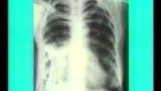 225 Pleural Calcification  Chest XRays  Dr Vaidya [upl. by Aliahs220]