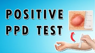 Positive PPD Test [upl. by Shishko904]