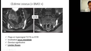 Cédric LUKAS Lecture des IRM sacro iliaques [upl. by Sedda861]
