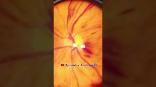 Diabetic retinopathy  Hemorrhages  proliferative diabetic retinopathy PDR  Short Video 184 [upl. by Erek923]