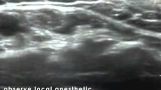 Axillary Nerve Block  In Plane Approach [upl. by Labina]