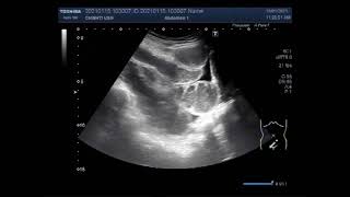 Intestinal Obstruction with minimum free fluid between the gut loops [upl. by Bamby]