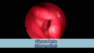 Endoscopia de nariz y cuerdas vocales  Dr Ilia Sterik Miguel Lara [upl. by Iharas]