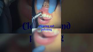 Debonding  placement of fixed lingual Retainer  teeth cleaning  polishing Dr Babita verma MDS [upl. by Sonahpets]