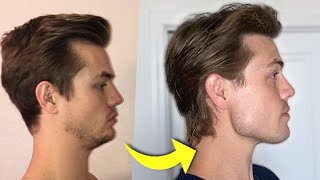 How I Fixed My Receding Chin [upl. by Garson]