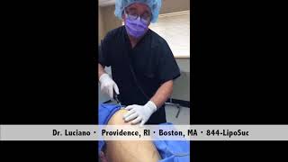 Vaser smooth for cellulite by Dr Luciano [upl. by Inalaeham484]