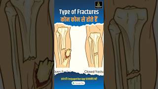 Common types of Bone fracture  Types of Fracture  facture bones shortvideo testpaperlive [upl. by Nevada168]