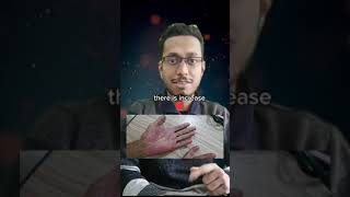 1 minute Clinical Short  Palmar Erythema  NEET SS Medicine Mrmedicine99 [upl. by Ciredor]