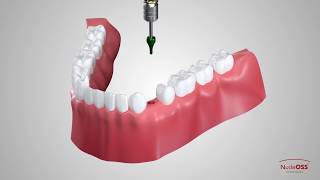 Single Crown Restoration With T6 Standart Abutment [upl. by Sorcim]