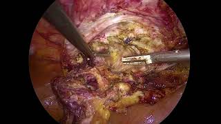 Recurrent Inguinal hernia Repair Mesh Removal Metin Ertem MDFACS [upl. by Carolynn461]