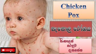 Chickenpox diseaseපැපොල රෝග තත්ත්වයcauseshow it happenstreatmentssinhalahow to prevent [upl. by Ireg]