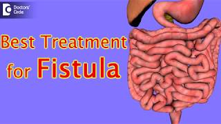 What is the best treatment for fistula  Dr Rajasekhar M R [upl. by Irb18]