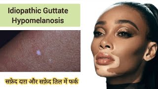 Idiopathic Guttate Hypomelanosis  सफ़ेद तिल और सफ़ेद दाग़ में फर्क IGH vitiligo leucoderma सफ़ेद [upl. by Elatan]