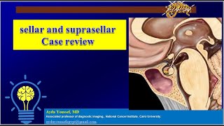 sellarsuprasellar lesions [upl. by Areval]