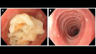 Eosinophile Ösophagitis [upl. by Nadnal202]