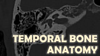 Anatomy of the Temporal Bone on Imaging [upl. by Hairehcaz]