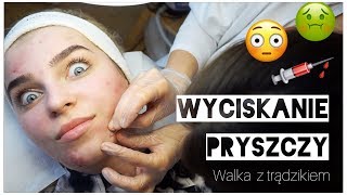 WYCISKANIE PRYSZCZY 😱💉 walka z trądzikiem 💪 [upl. by Neivad795]