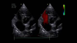 Pulmonary Hypertension in a dog [upl. by Arak]