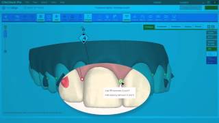 ClinCheck Pro IPR e Espaços  Sistema Invisalign  Blumenau SC [upl. by Azilanna]