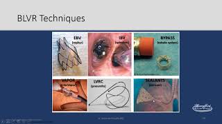 Bronchoscopic Management of COPD [upl. by Domonic741]