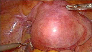 Large fibroid uterus TLH unedited [upl. by Jard516]