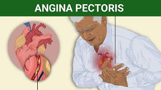 Angina pectoris EtiologyClinical FeaturesPathophysiologyMedical Management  Complication [upl. by Connelley498]