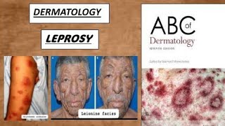 DERMATOLOGY  LEPROSY tuberculoid amp lepromatous derma lesion leprosy [upl. by Nim744]