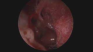 Timpanoplastia transcanal endoscópica [upl. by Olecram]