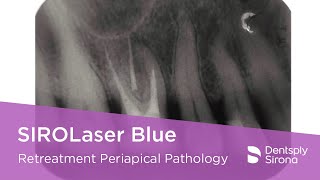 SIROLaser Blue  Retreatment of First Upper Molar Periapical Pathology [upl. by Noxas]