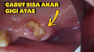 CABUT GIGI  SISA AKAR GIGI  PENCABUTAN GIGI ATAS  Dentist  Dokter Gigi Tri Putra [upl. by Tish534]