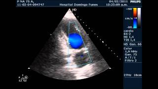 Insuficiencia Coronaria y Miocardiopatia Hipertrofica Septal Primariawmv [upl. by Mendoza]