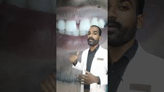 🦷FRONT TEETH GAP🔍 TREATMENT shortsfeed cosmeticdentistry shortsfeeds tamildentist dental [upl. by Gnet]