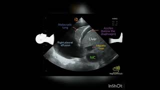 Pleural effusion on Ultrasound POCUS [upl. by Gerge670]