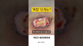 욕창 단계는 깊은 욕창 죽은 조직 제거술 수술 병원 pressure sore bedsore surgery hospital seoul korea아문TV [upl. by Malin770]