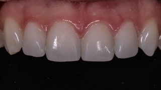 Composite Veneers [upl. by Adnaugal]