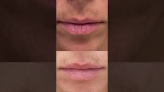 Hyperpigmentation Around Mouth Treatment That Works shorts [upl. by Partridge]