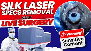 SiLK Laser Specs Removal  Near LIVE Surgery by Dr Rahil Chaudhary [upl. by Otanod]