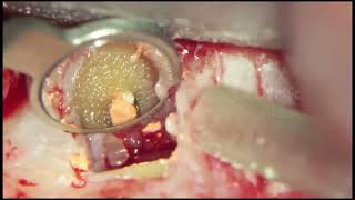 Endodontic MicroSurgery [upl. by Yllehs808]