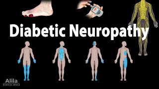 Diabetic Neuropathy Animation [upl. by Eca987]